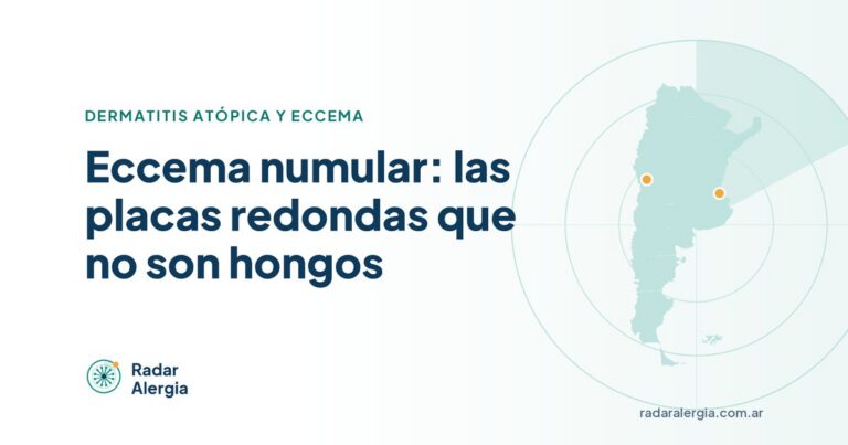 Radar Alergia: Eccema numular: las placas redondas que no son hongos